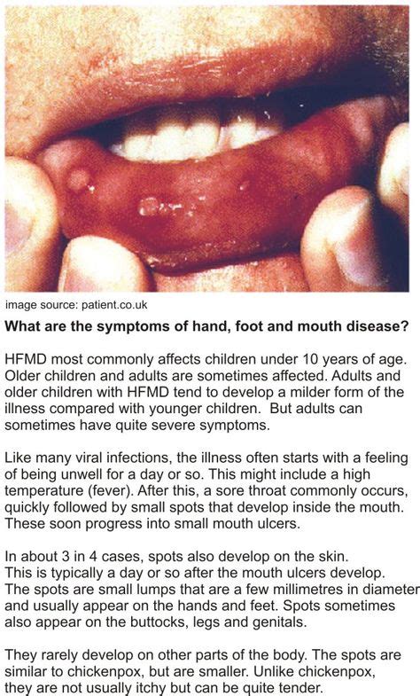 Hand Foot Mouth Disease Adults Symptoms Pictures Hand Foot Mouth