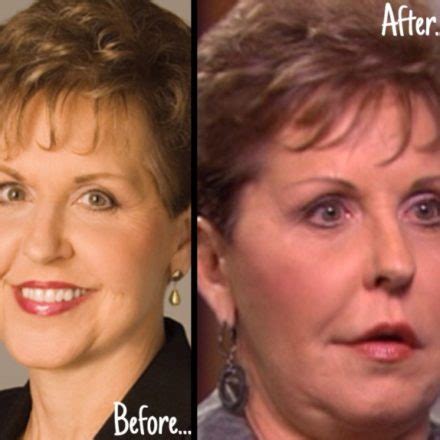 Joyce Meyer Plastic Surgery Really