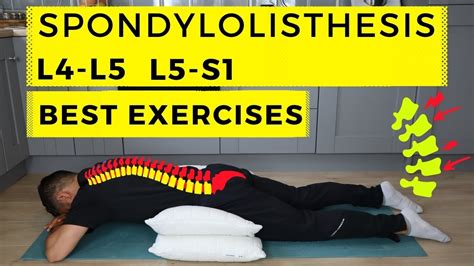 Spondylolisthesis Treatment Youtube