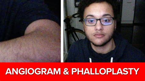 Ftm Angiogram And Phalloplasty Vlog 1 Youtube