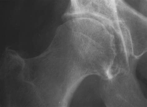 Rapidly Destructive Osteoarthritis Of The Hip Mr Imaging Findings Ajr