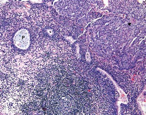 Squamous Cell Carcinoma Histology Ear