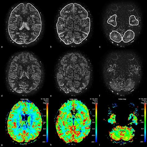 12 Areas Of Bilateral Cerebral And Cerebellar Hemispheres Brain Mri Of