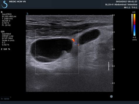 Reactive Lymph Nodes In Neck Ultrasound