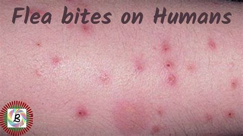 How To Identify Flea Bite Allergies On Humans Flea Bites In Humans