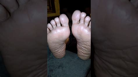 Dry Thick Wrinkled Soles Youtube