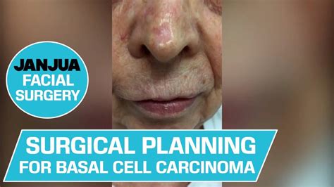 Basal Cell Carcinoma Of The Outer Nose Overview On Surgical Techniques My Xxx Hot Girl