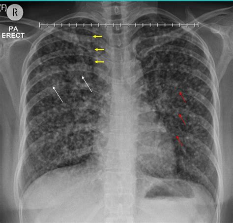 Lung Adenocarcinoma Radiology Cases