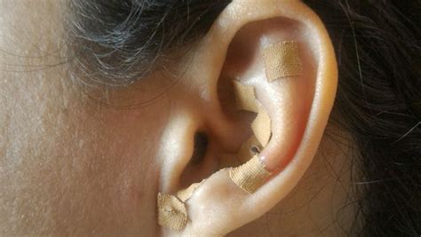 Does At Home Ear Seed Acupuncture Work Unified Practice