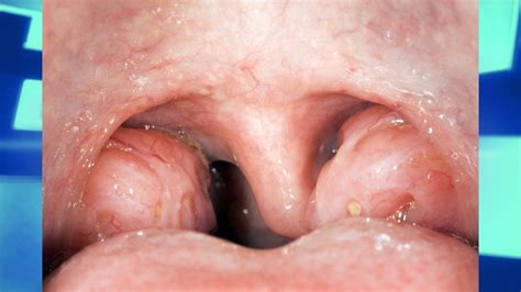 0 Result Images Of Green Phlegm And White Spots On Tonsils Png Image
