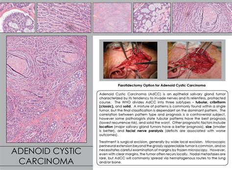 adenoid cystic carcinoma