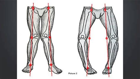 How To Correct Bow Legs In Adults Without Surgery Youtube