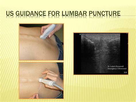 Ppt Ultrasound Guided Lumbar Puncture Powerpoint Presentation Free