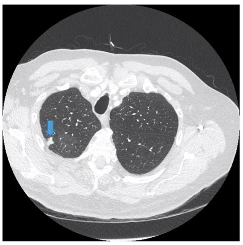 Incidental Ill Defined Nodular Lung Opacities Discovered During Ct