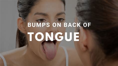 Bumps On Back Of Tongue Causes Remedies And Treatments