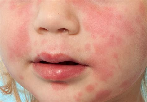5 Rashes Your Child May Bring Home From Preschool Cleveland Clinic