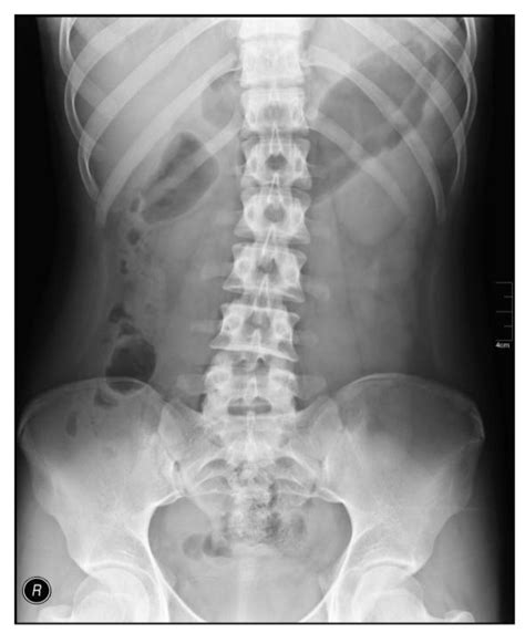 Radiograph may done prone as a pa projection, which places the intervetebral spaces more closely parallel to the diverging rays. Back Pain and Disorders of the Spine | Match and Farnsworth