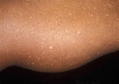 White Spots On Legs Causes