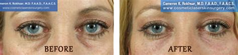 Non Surgical Eyelid Lift In Nyc And Long Island