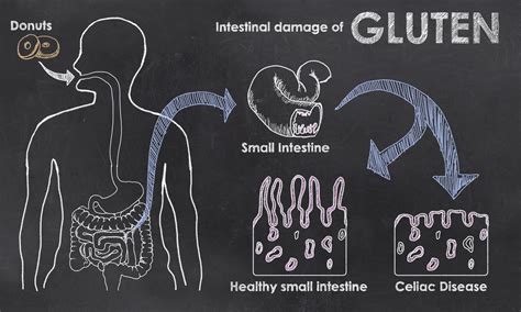 Turning On Celiac Disease The Pediablog