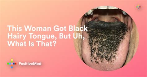 What To Do About Black Hairy Tongue What Is That Positivemed