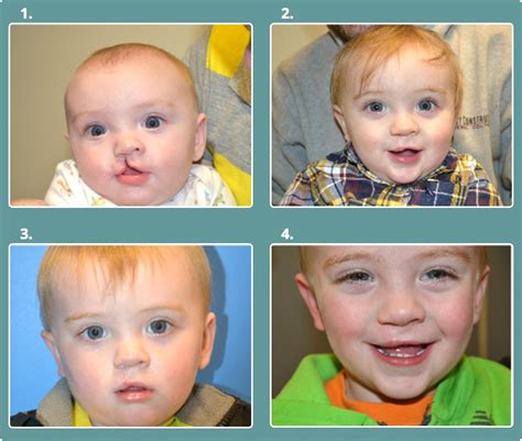 Before And After Cleft Lip And Palate Michael Bateman Md Pc