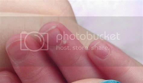 White Bump On Finger Babycenter