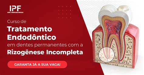 Curso Tratamento Endodôntico em dentes permanentes com a Rizogênese Incompleta