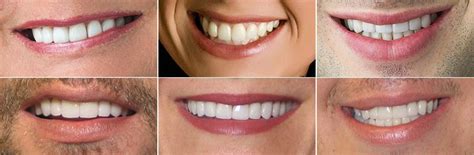 What Smiles Mean Scott Young Dds Cosmetic General And