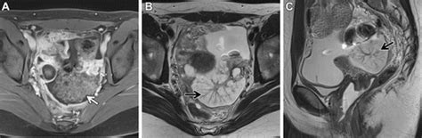 Ovarian Serous Surface Papillary Borderline Tumor Sea Anemone Sign