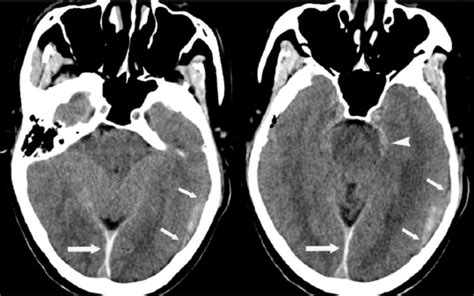 Subdural Hematoma Caused By Rupture Of A Posterior Cerebral Artery