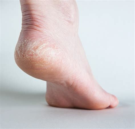 Home Remedies For Dry Or Cracked Feet Thriftyfun