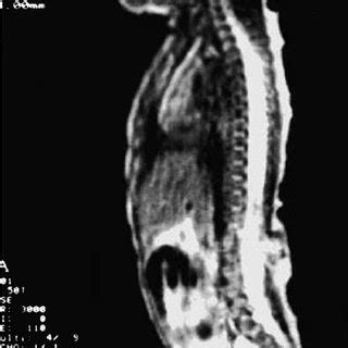 T Weighted Sagittal Magnetic Resonance Imaging Scan Of The Lumbar My