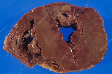 Heart Disease Stock Image M1720588 Science Photo Library