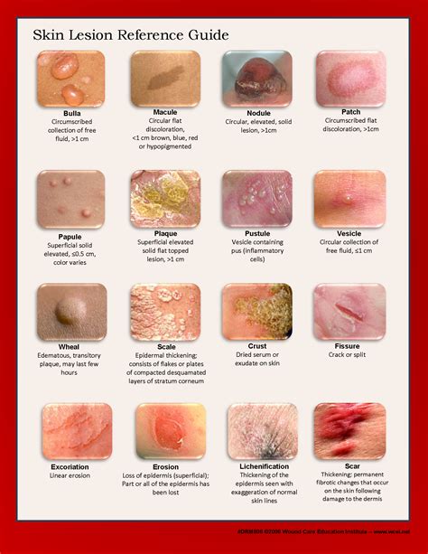 Skin Lesion Identification Chart