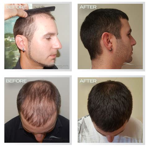 Norwood 7 Hair Transplant Before And After Before And After