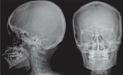 Lateral Skull X Ray