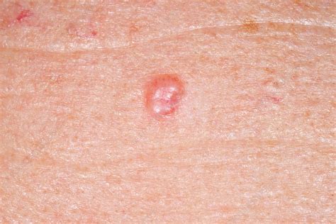 Basal Cell Carcinoma Skin Cancer Stock Image C Science Photo Library