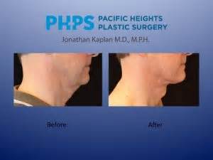 Adam S Apple Surgery How To Get It Back Pacific Heights