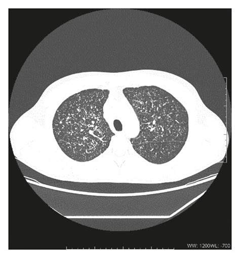Axial Chest Computed Tomography With The Presence Of Innumerable Small