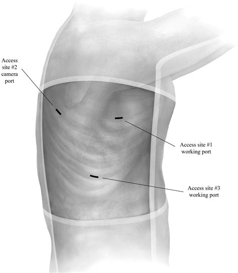 Thoracoscopic Thoracic Duct Ligation Operative Techniques In Thoracic