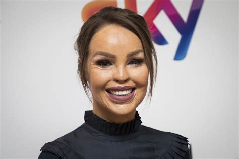 Katie Piper Recovering After Eye Operation