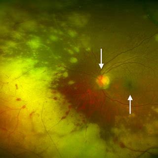 Mucormycosis, a subtype of a larger category of diseases known as zygomycoses, is an aggressive opportunistic infection which tends to show a proclivity for, among other sites (namely the lungs and gastrointestinal tract). Rhino-orbital mucormycosis. (A) Acute orbital cellulitis ...