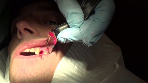 Tooth Extraction Warning Blood Youtube