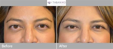 Graves Disease Before And After Gallery Taban Md
