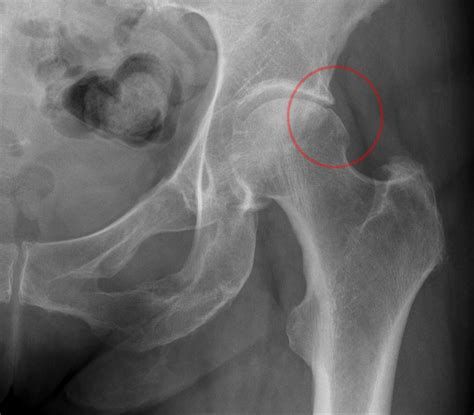 Femoroacetabular Impingement Surgery Globehealer