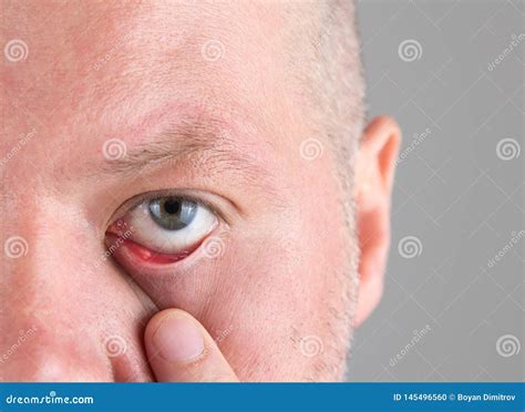 Painful Stye In Corner Of A Woman Eye Stock Photography Cartoondealer