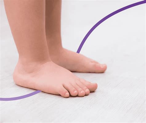 Flat Feet In Children Causes Symptoms And Treatment