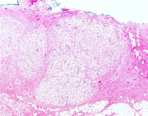 Pathology Outlines Myxoinflammatory Fibroblastic Sarcoma
