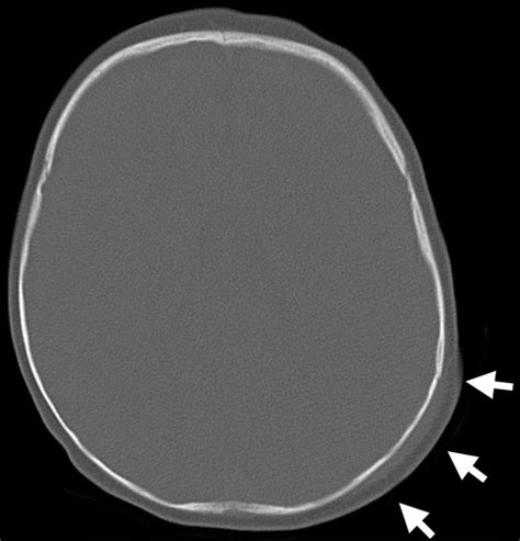 Ct Of Normal Developmental And Variant Anatomy Of The Pediatric Skull